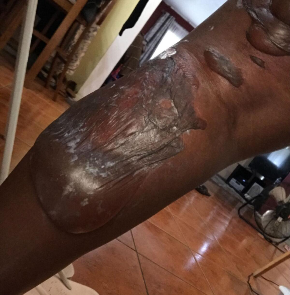 Image of burn injuries suffered by a Starbucks customer after a coffee spill incident, highlighting the severity of such cases and the need for accountability.